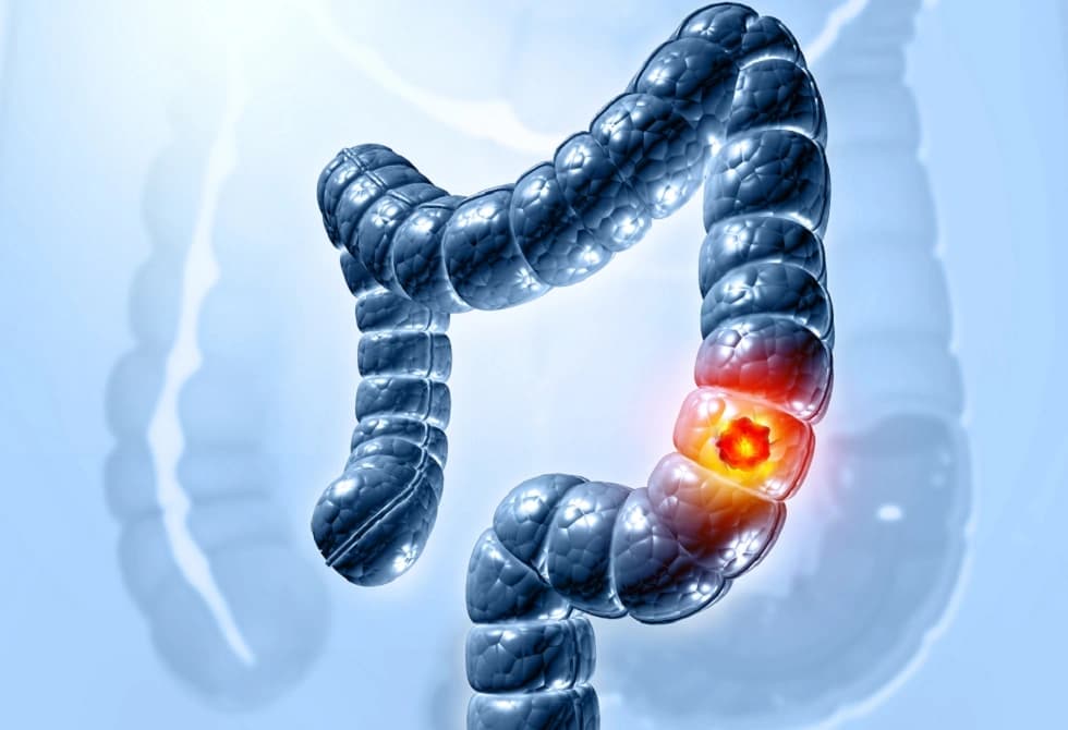 عامل خفي يزيد من خطر سرطان القولون